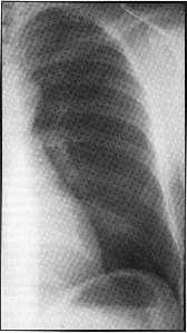 X-Ray of thirty year old male lung